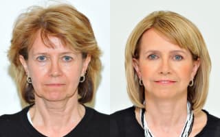 Facelift