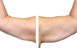 Lipotransfer