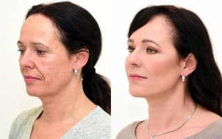 Eyelids surgery