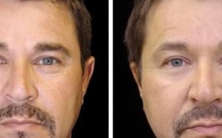 Eyelids surgery