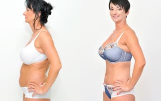Lipotransfer