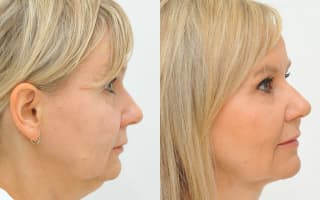 Double chin liposuction