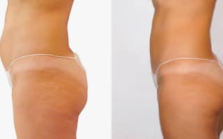 Lipotransfer