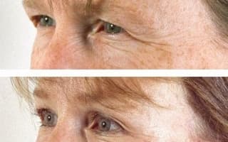 Eyelids surgery
