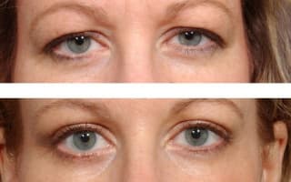Eyelids surgery