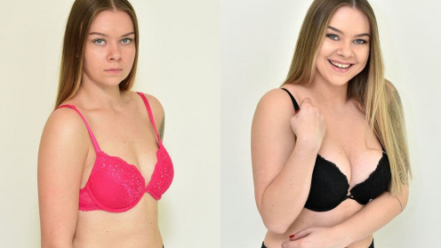 Breast enlargement
