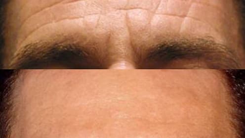 Wrinkles