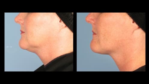 Double chin liposuction