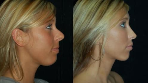 Nose surgery