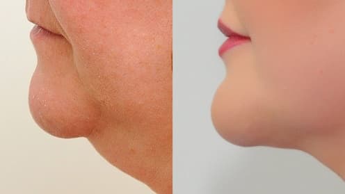 Double chin liposuction