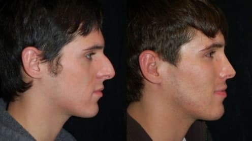 Nose surgery