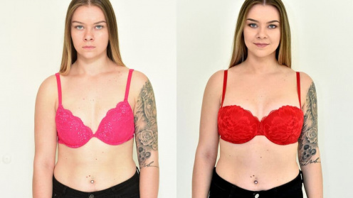 Breast enlargement