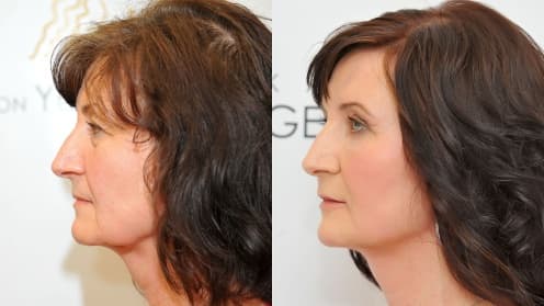 Eyelids surgery