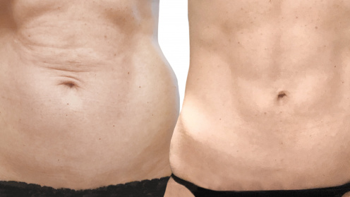 Lipotransfer
