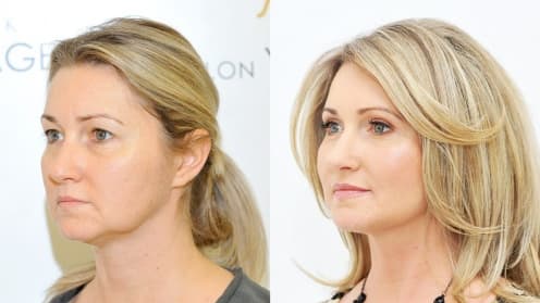 Eyelids surgery