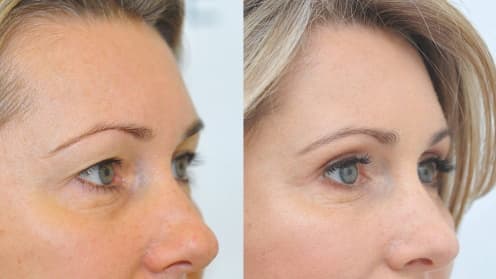 Eyelids surgery