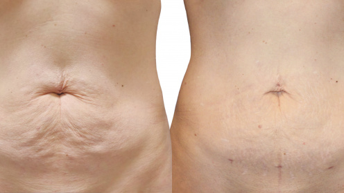 Lipotransfer