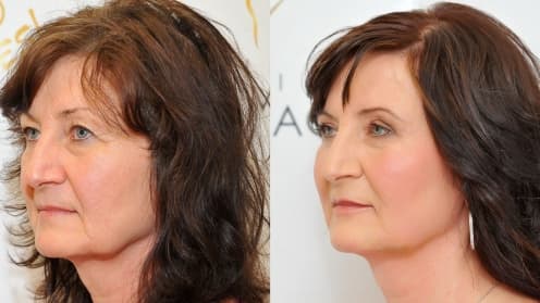 Eyelids surgery