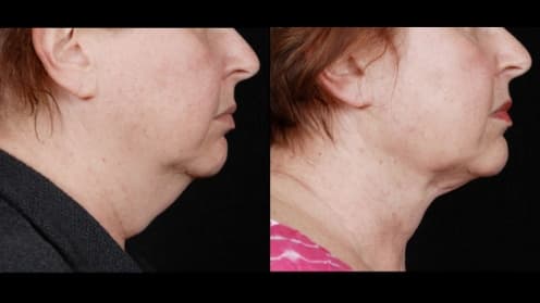 Double chin liposuction