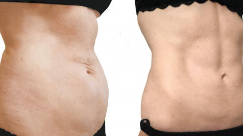Lipotransfer