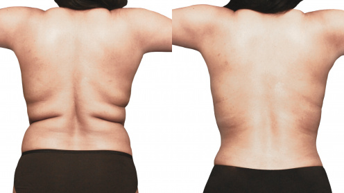 Lipotransfer