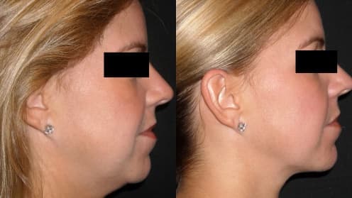 Double chin liposuction