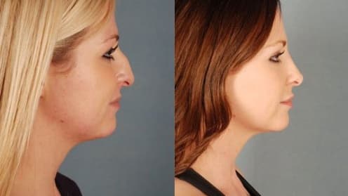 Nose surgery