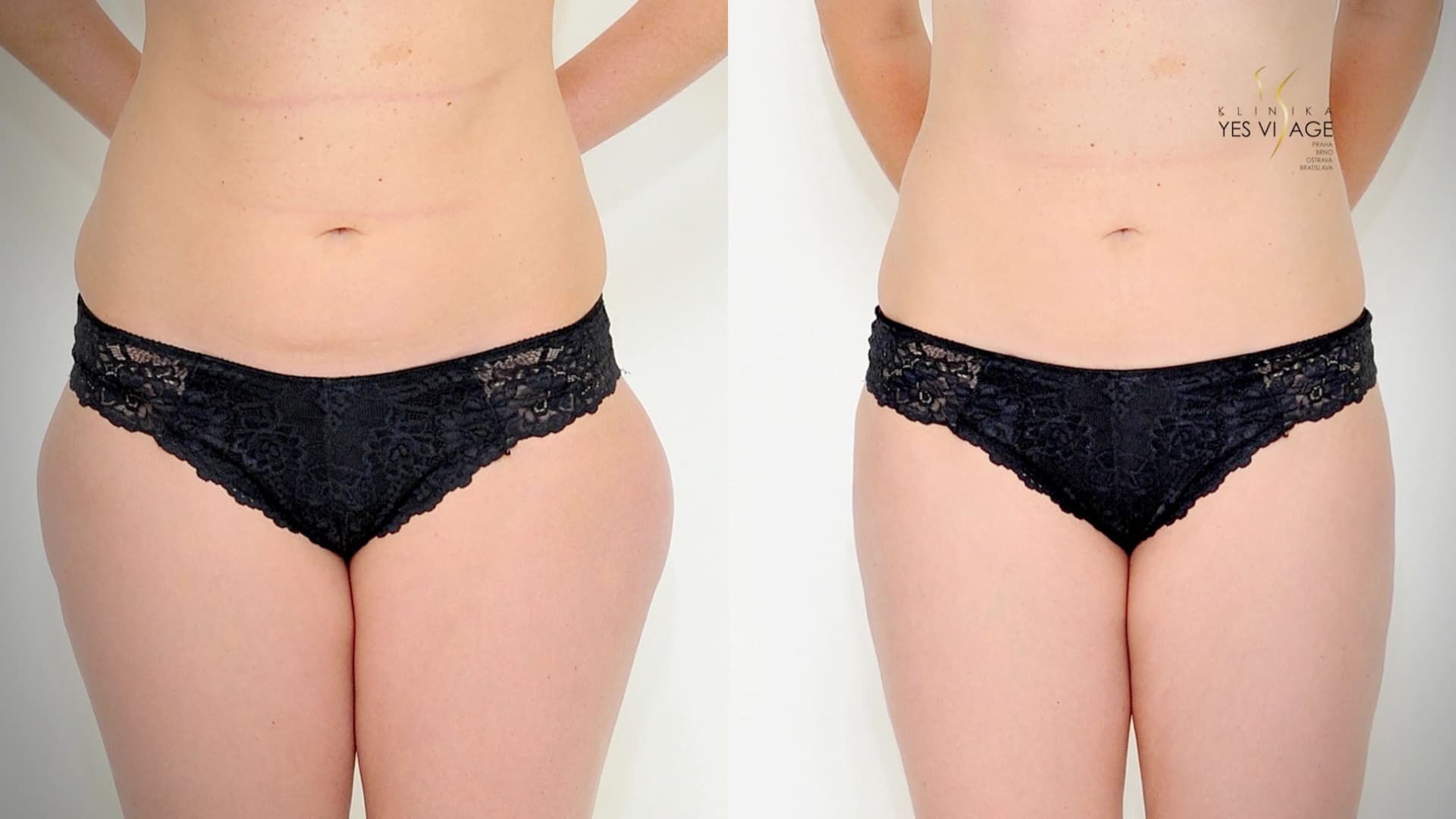 Lipotransfer - Prenos tuku na Klinike YES VISAGE