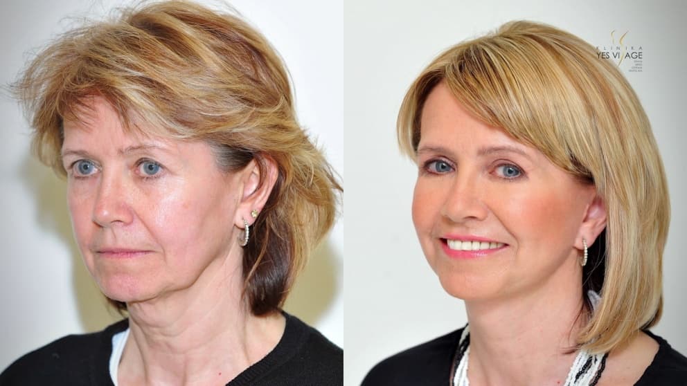 TRANSFORMATION: Facial plastic surgery