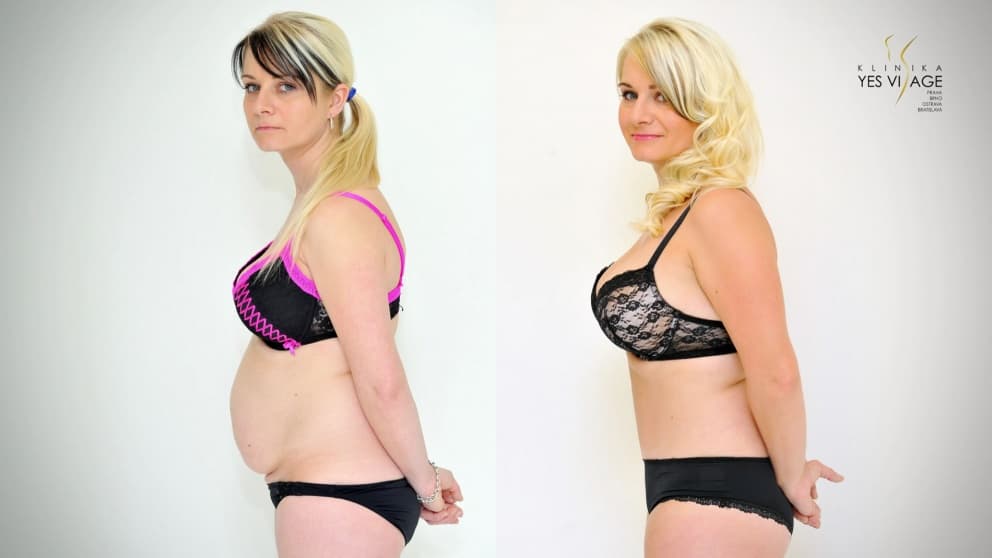TRANSFORMATION: Abdominoplasty - tummy tuck