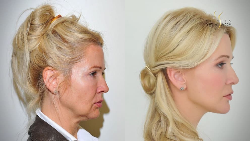 Thread lifting, facelift - Lenka