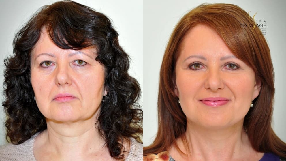Facelift, necklift, eyelid adjustment - Alena