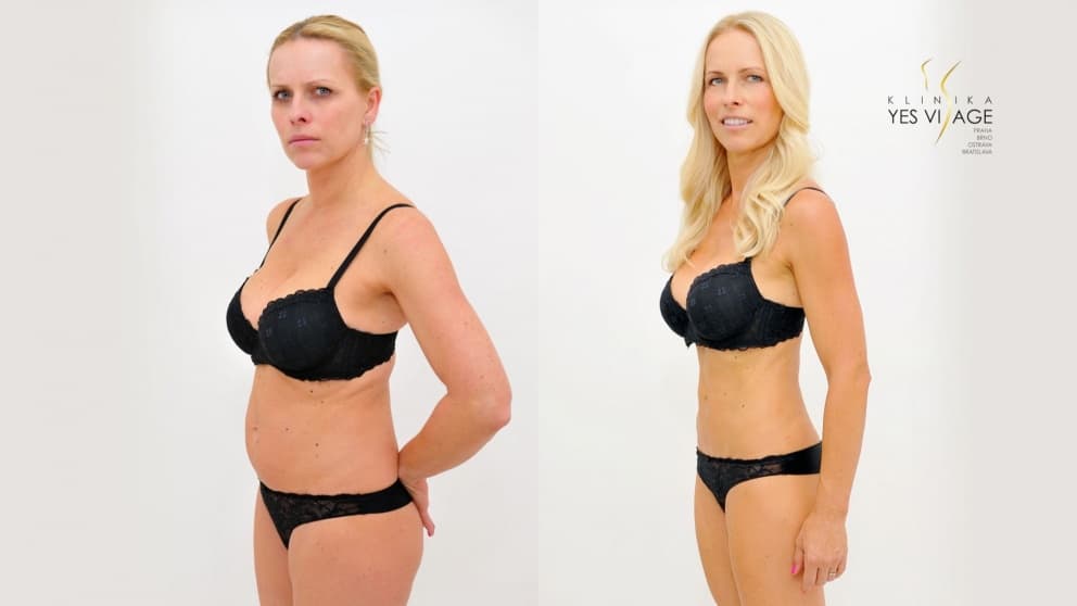 SlimLipo Laser Liposuction