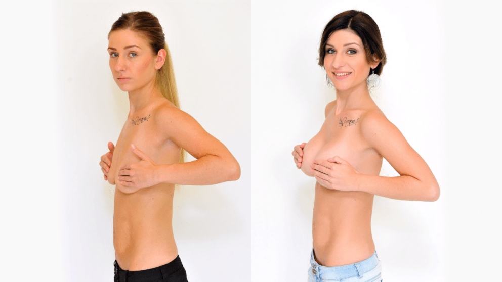 Breast enlargement and modeling at YES VISAGE Clinic