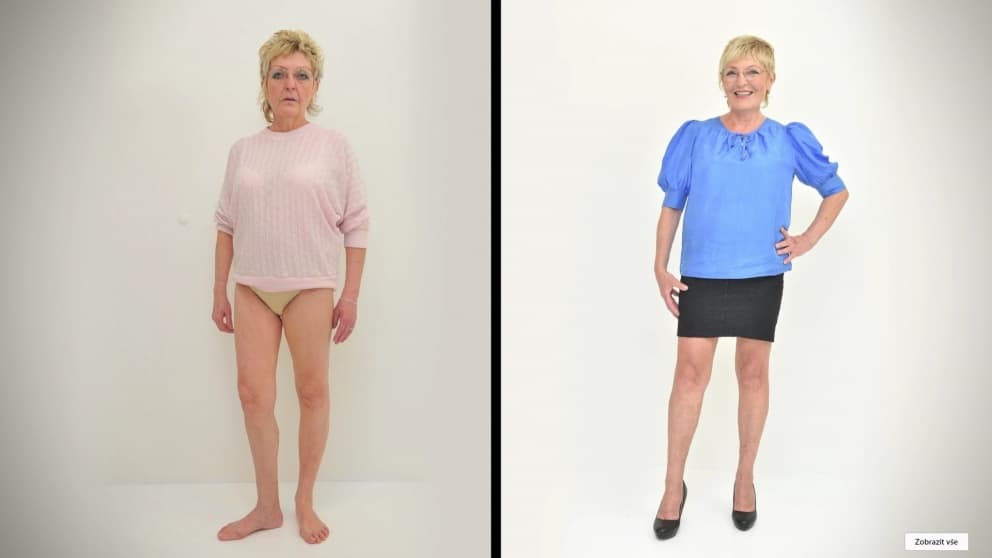 Removal of varicose veins - Jana