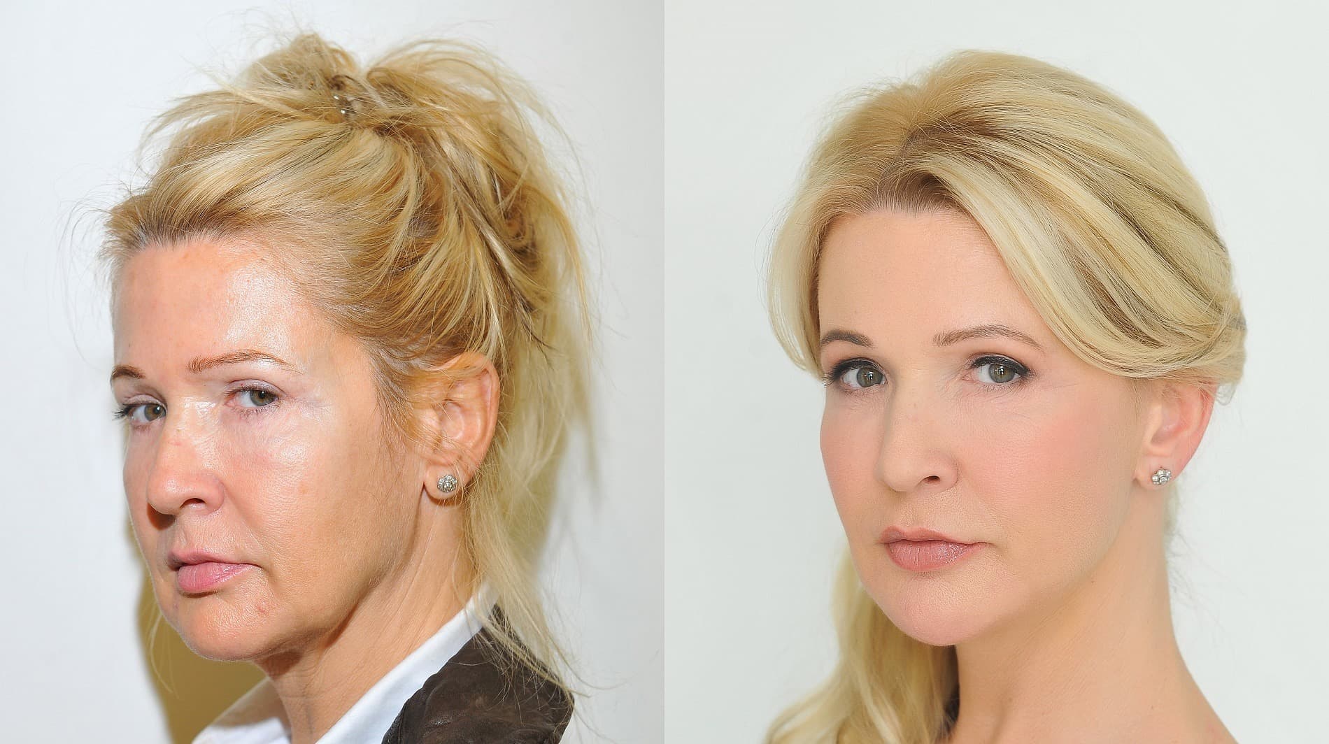 Brow Lift London